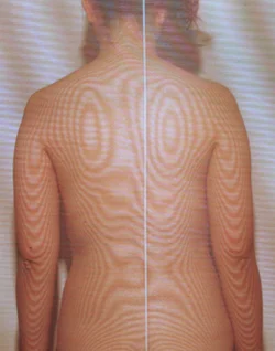 モアレトポグラフィー：鍼治療前