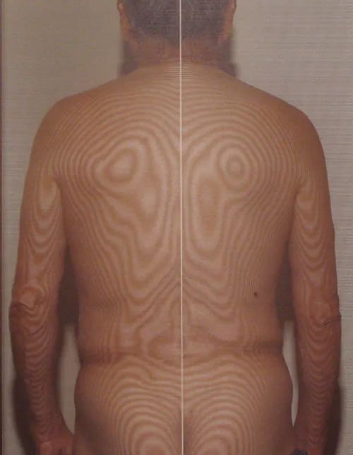 モアレトポグラフィ：鍼治療後の体の歪み画像
