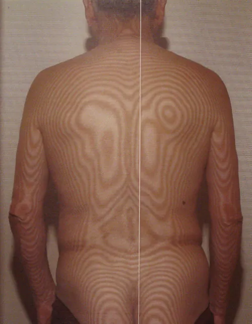 モアレトポグラフィ：鍼治療前の体の歪み画像