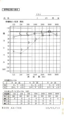 ストレスが原因で低音の左聴力が低下した左耳突発性難聴|治療前のオージオグラム