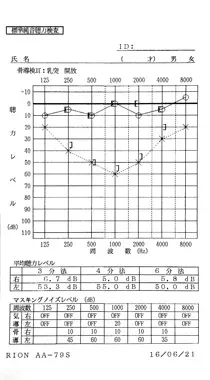血液循環の悪化が原因で、中音域の左聴力が低下した左耳突発性難聴|治療前のオージオグラム