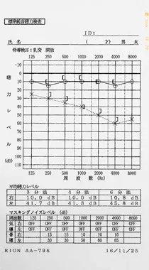 鍼治療で聴力が回復したウイルス感染が原因の左耳突発性難聴|治療後のオージオグラム