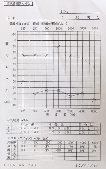 聴覚補充現象 治療前のオージオグラム