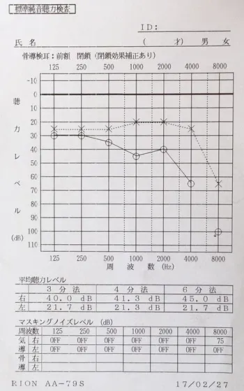 聴覚補充現象 治療後のオージオグラム