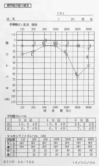 鍼治療と音響療法をする前のオージオグラム