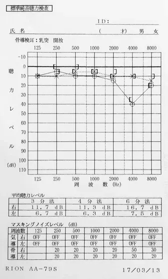 鍼治療と音響療法で聴力が改善したオージオグラム