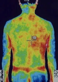 ストレスが原因の左耳突発性難聴|サーモグラフィ画像