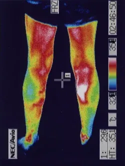 耳管機能不全症|鍼治療で温度が上がったふくらはぎ(治療後)