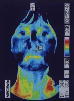 ストレスで顔の温度が低下したサーモグラフィ画像:治療前