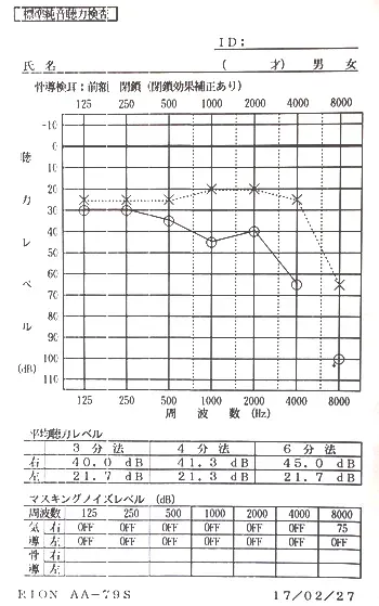 右耳の聴力が回復したオージオグラム:鍼治療後