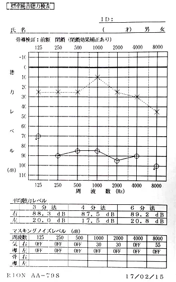 右耳の聴力が低下したオージオグラム:治療前