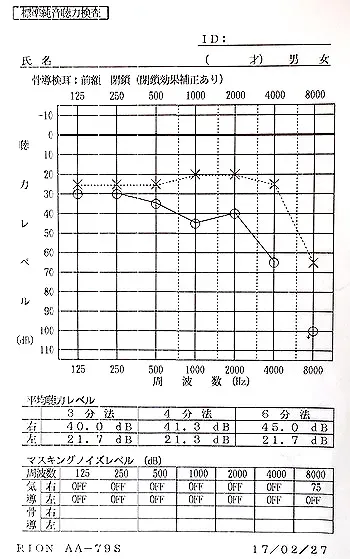 片耳の聴力が改善してきた鍼治療後のオージオグラム(聴力図)