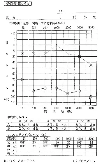 片耳の聴力が低下した鍼治療前のオージオグラム(聴力図)