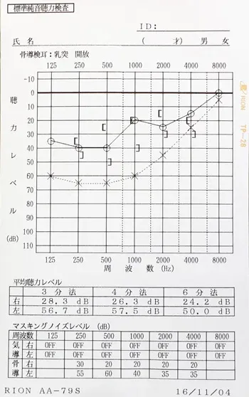 オージオグラム：低音障害型感音難聴の鍼治療前