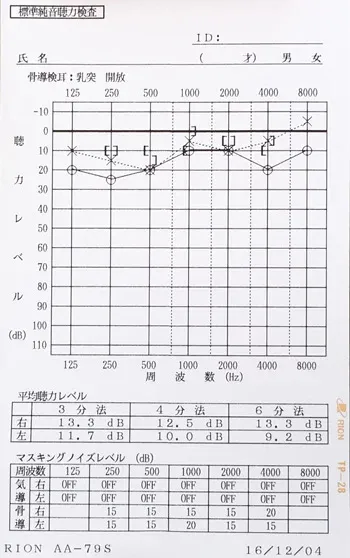 オージオグラム：低音障害型感音難聴の鍼治療後