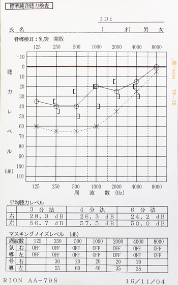 急性急性低音型感音難聴 治療前 オージオグラム