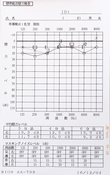 急性急性低音型感音難聴 治療後 オージオグラム