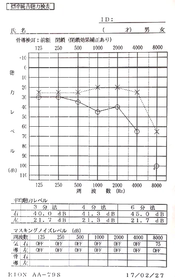 鍼治療で聴力の回復が始まったオージオグラム