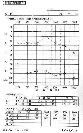 突発性難聴で退院直後の全域スケールアウトのオージオグラム