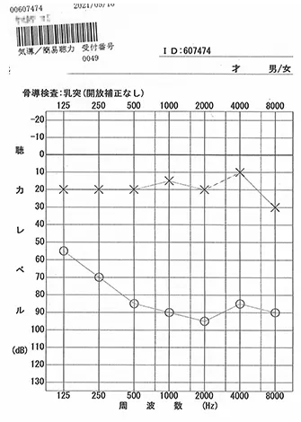 鍼治療で聴力の回復が始まったオージオグラム