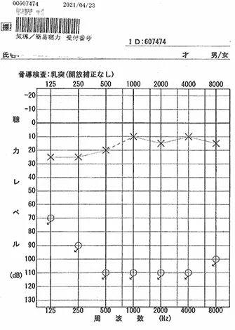 突発性難聴で退院直後の全域スケールアウトのオージオグラム