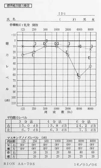 鍼治療と音響療法をする前のオージオグラム