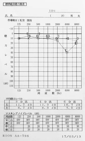 鍼治療と音響療法で聴力が改善したオージオグラム
