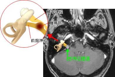聴神経腫瘍の場所を示した画像