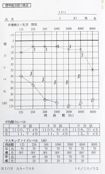 聴力が低下した外リンパ瘻 患者様のオージオグラム 治療前