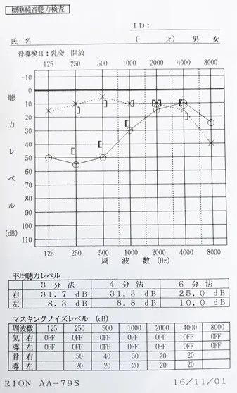 鍼治療で聴力が回復した外リンパ瘻 患者様のオージオグラム 治療後