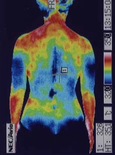 体のサーモグラフィ：低音障害型感音難聴の鍼治療後