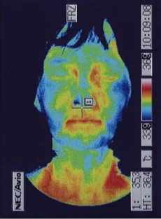 サーモグラフィ：突発性難聴の鍼治療後