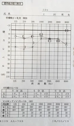 鍼治療前の突発性難聴
