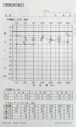 鍼治療でよくなった突発性難聴