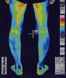 鍼治療で体温が上がったふくらはぎ