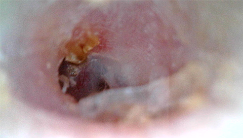 穴が開いた鼓膜｜レーザー治療から1週間