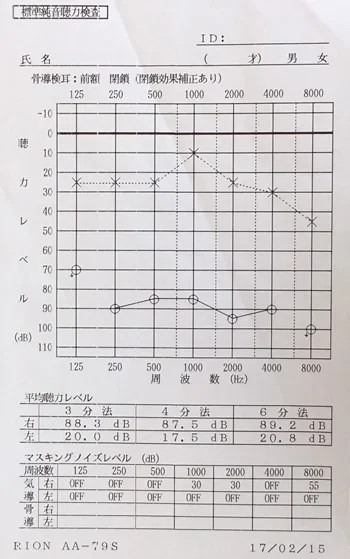 オージオグラム：突発性難聴治療前