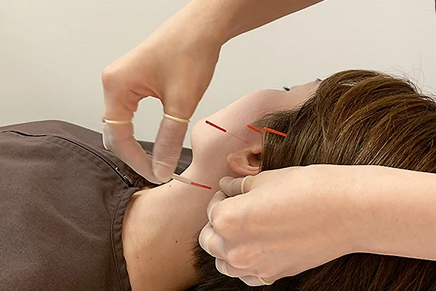 森上鍼灸整骨院：突発性難聴の鍼治療