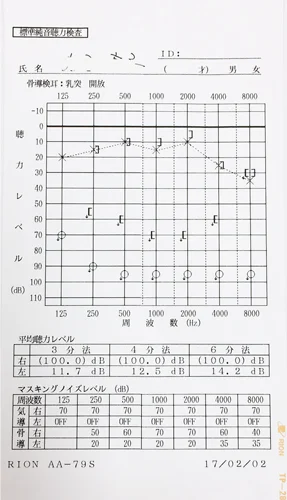 聴力が低下している心因性難聴のオージオグラム