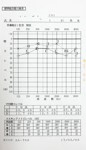 鍼治療で聴力が回復した心因性難聴のオージオグラム