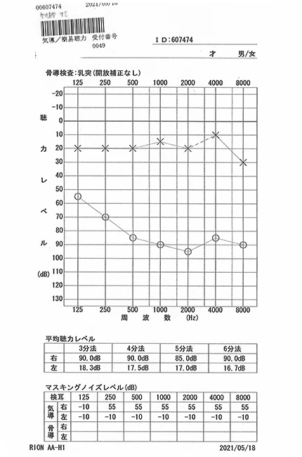 ストレスが原因の突発性難聴｜オージオグラム検査（治療後）