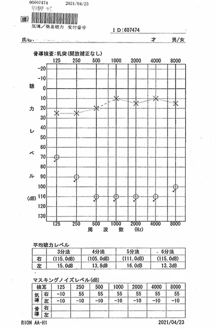 ストレスが原因の突発性難聴｜オージオグラム検査（治療前）