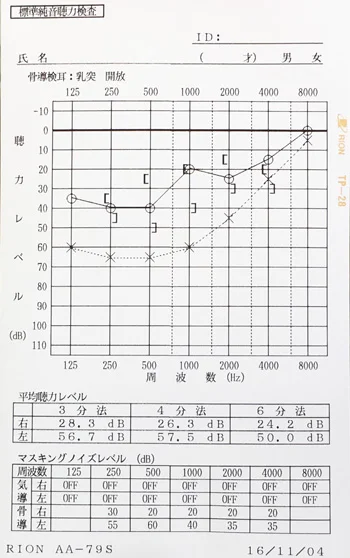 オージオグラム：低音障害型感音難聴の鍼治療前